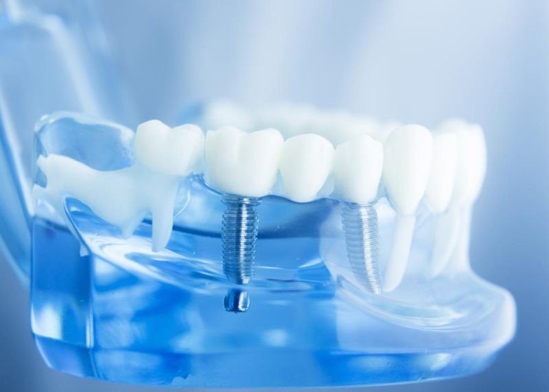 PHẪU THUẬT CẤY GHÉP IMPLANT: GIẢI PHÁP TỐI ƯU CHO NGƯỜI BỊ MẤT RĂNG LÂU NĂM